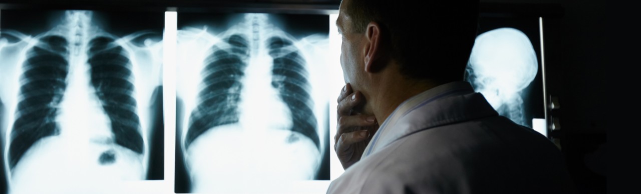 doctor reviewing x-rays of person's chest