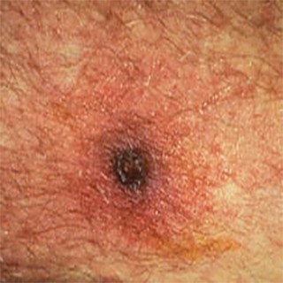 scrub typhus eshar -320x320